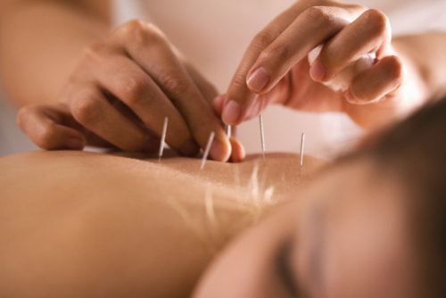 An acupuncturist giving acupuncture in Kelowna.