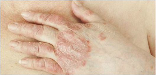 skin problems caused by autoimmune disease treatment in Kelowna